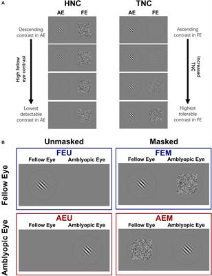 A New Dichoptic Training Strategy Leads to Better Cooperation Between the Two Eyes in Amblyopia